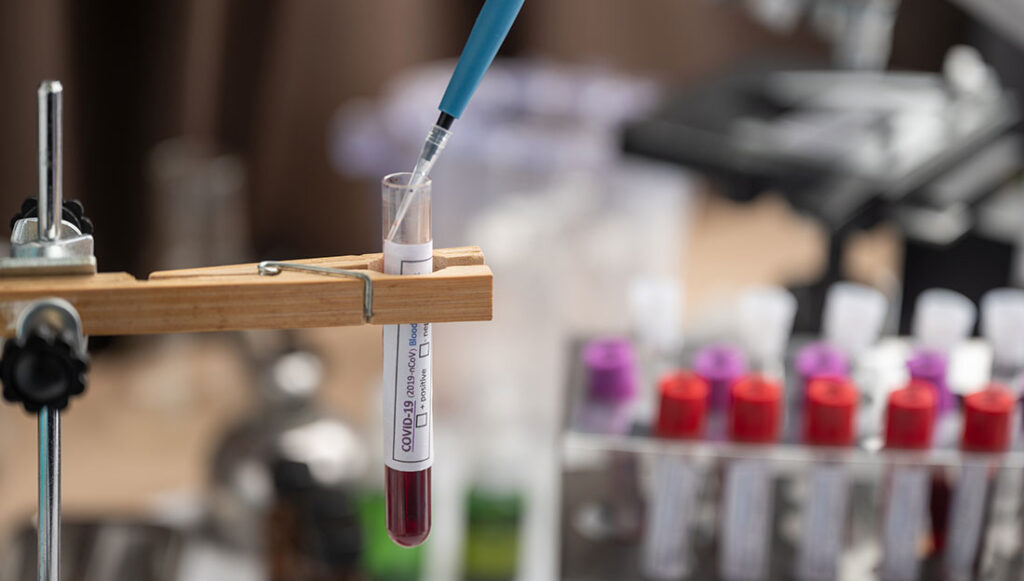 blood sample test tube in laboratory