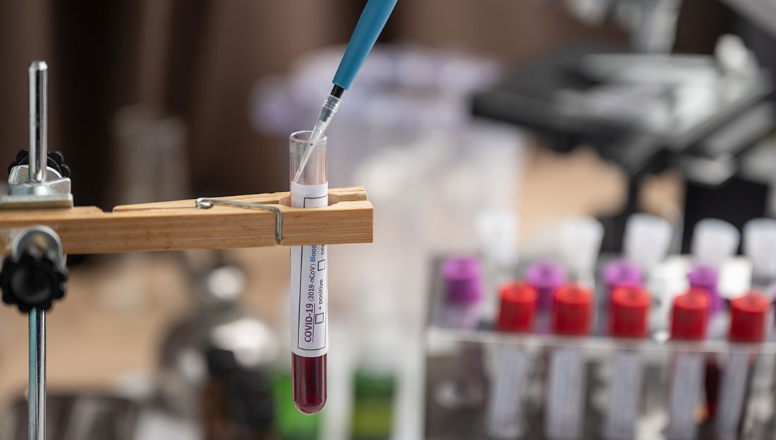blood sample test tube in laboratory